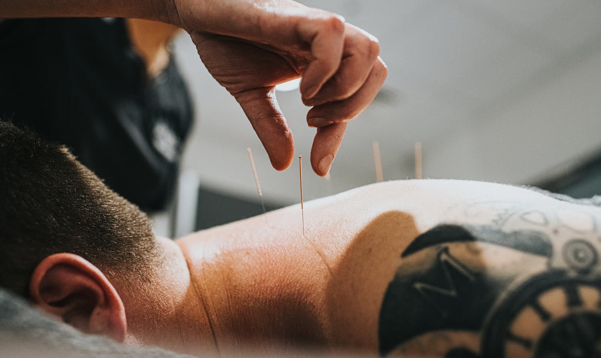 acupuncture