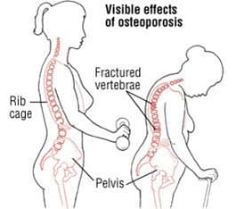 Diagram showing the visible effects of osteoporosis, including fractures in the rib cage and the pelvis