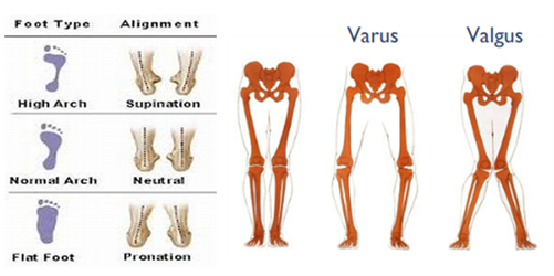 A diagram showing the differences between foot arch types, and alignment of knees