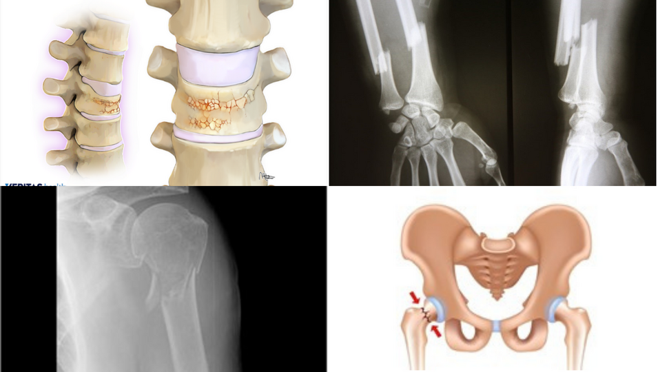 Collage of diagrams of the effects of osteoporosis on the spine and the hip, and x-ray images of broken arms due to osteoporosis
