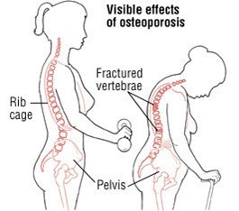 Diagram showing the visible effects of osteoporosis, including fractures in the rib cage and the pelvis