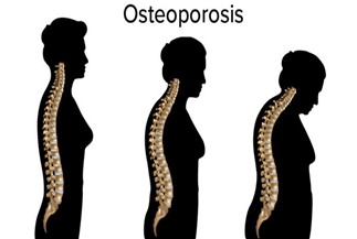 Illustration showing the decline of spinal posture due to osteporosis